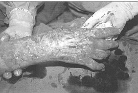 Fig. 3b - Cas clinique n' 3. Excision, avec exposition de