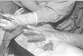 Fig. 3c - Cas clinique n' 3. Lambeau-greffe abdominal