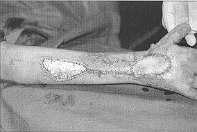 Fig. 3d - Cas clinique n' 3. Nécrose trophique secondaire du dos de la main avec rupture tendineuse, réparation tendineuse, et couverture par un lambeau interosseux postérieur.
