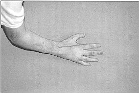 Fig. 3e - Cas clinique n' 3. Résultat à distance après