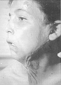 Fig. 1 - Séquelle de brulure cervico-j u go