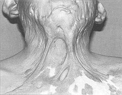 Fig. 3 - Rétraction cervicale antérieure.