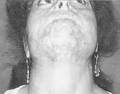 Fig. 5 - Séquelle de brûlure pan-faciale.