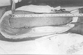 Fig. 2 - Dissection of flap together with deep fascial layer (starting from posterior part)