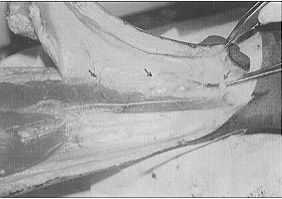 Fig. 3 - Dissection of medial septocutaneous vessels in fresh cadaver.