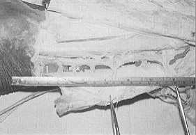 Fig. 4a - Formalin-preserved leg. Six septocutaneous vessels arising directly from posterior tibial vessels.