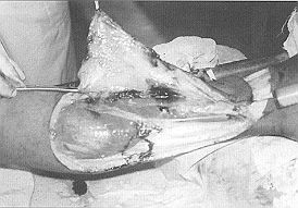 Fig. 5 - Lowermost septal vessel cannulated 