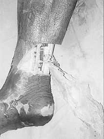 Fig. 10a - Wide arc of rotation of medial 