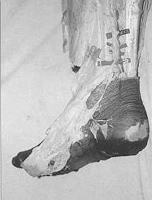 Fig. 10b - Wide are of rotation of medial septofascial
