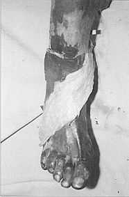 Fig. 10c - Wide arc of rotation of medial