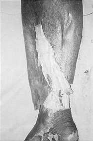 Fig. 10d - Wide arc of rotation of medial septofascial