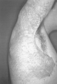Fig. 1 - Patient with hypertrophic burn scar in right shoulder. Elastocompressive and topical therapy initiated two weeks after healing.