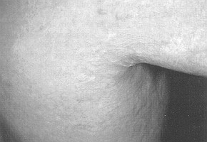 Fig. 2 - Result after six months treatment.
