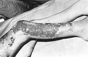Fig. I - Case 1. De-epidermidized allografted