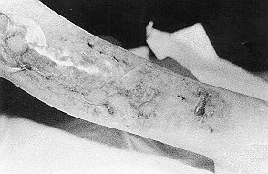 Fig. 2 - Case 1. Wound after second culture graft, 