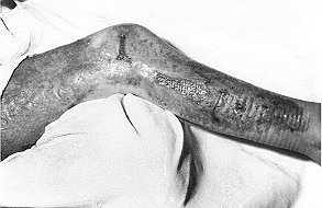 Fig. 3 - Case 1. Patient ready for release after 3 weeks