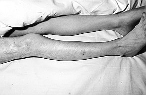 Fig. 4 - Case 1. Appearance of wound after 3 years.