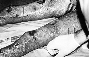 Fig. 5 - Case 2. Right leg 10 days post-grafting showing site of biopsy (x).