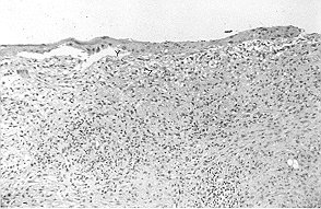 Fig. 6 - Case 2. Biopsy section showing narrow epidermal layer (y) loosely attached to fascia (z) of wound bed.