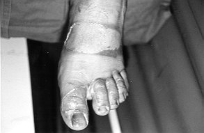 Fig. la - Second-degree superficial bum in left foot and toes.