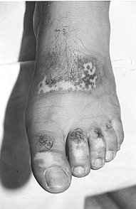 Fig. lb - Healed area showing dyschromia.