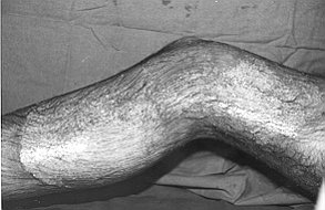 Fig. 2a - Mixed bum in right thigh and leg.