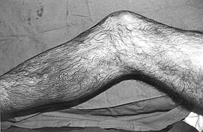 Fig. 2b - Appearance after three weeks of Solcoseryl treatment.