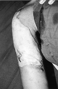 Fig. 3a - Burn in right arm, mostly deep second-degree deep.