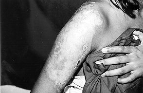 Fig. 3b - After two weeks of Solcoseryl treatment.