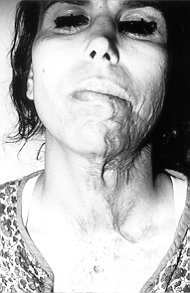 Fig. la - Bride mento-cervico-thoracique médiane