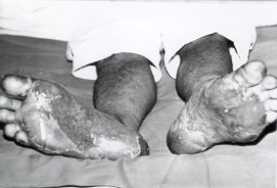 Fig. 3 - Bums to soles of the feet.