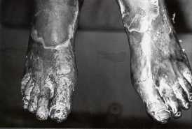 Fig. 4 - Burns to feet.