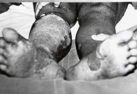 Fig. 5 - Bums to feet.
