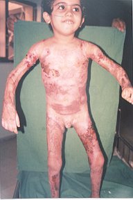 Fig. 3 - Burned child, 4 years old (70% TBSA), after grafting. 