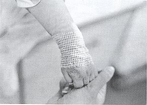 Fig. 1 - Application of keratinocytes in partial-thickness bum.