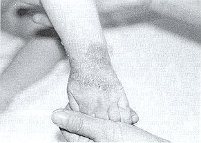 Fig. 2 - Partial-thickness bum after removal of keratinocytes (same .patient as Fig. 1).