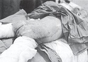 Fig. 3 - Application of keratinocytes in portion of partial-thickness bum in patient with extensive mixed bums.