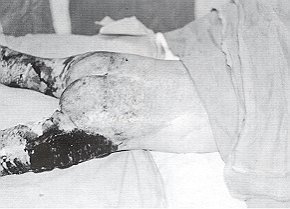 Fig. 4 - Healing of part of partial-thickness burn after removal of keratinocytes (same patient as Fig. 1).