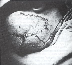 Fig. 3 - Ablation de l'expandeur. Couverture de la PDS pour le larnbeau expansé: rotation glissement.