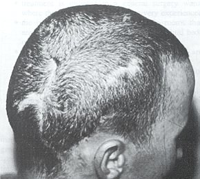 Fig. 4 - Résultat à un mois, persistance d'une alopécie linéaire facilement corrigible sans anesthésie locale.