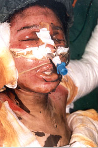 Fig. 1 - female patient, 60% TBSA burns with inhalation injuty