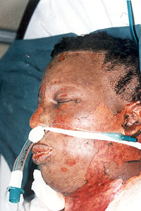 Fig. 2 - male patient, 61% TBSA burns with inhalation injury