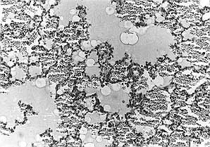 Fig. 2 - Six h post~injury, haemorrhage and swelling of lung tissues with aggregation and infiltration of a large number of phagocytes were seen. The alveolar spaces were flooded with oedematous fluid and red blood cells (HE x 400).