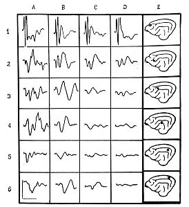 Fig. I - Influence of burn shock on evoked potentials of cerebral cortex by sciatic nerve stimulation.