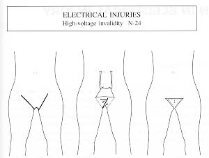 Fig. 3 - Amputation in 24 patients with high-voltage injuries. 
