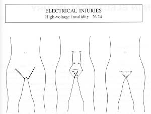 Fig. 3 - Amputation in 24 patients with high-voltage injuries.
