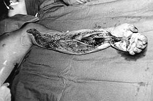 Fig. 1 - High-voltage electrical injury to upper extremity in 13-yearold boy following decompressive surgery.