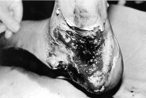 Fig. 2 - The other contact site on sole and heel 