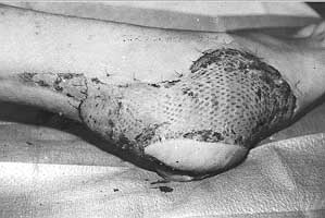 Fig. 4 - Another free muscular flap sutured to defect (foot).
