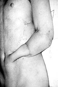 Fig. 5 - Stump covered with tubed flap already raised